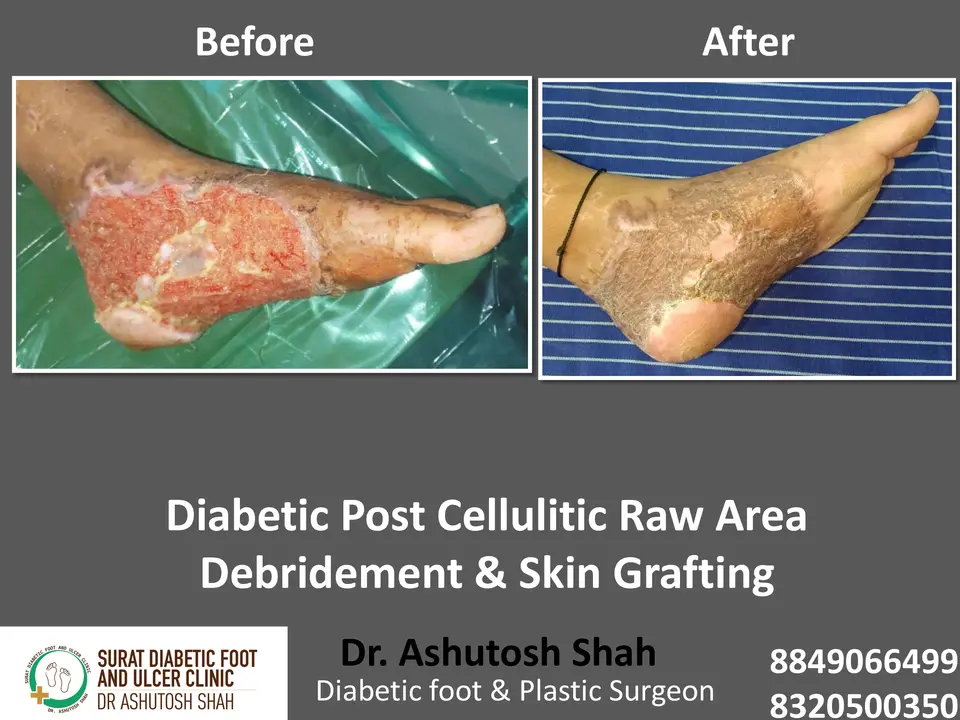 Diabetic Cellulitis and Coverage.pptx-17.webp